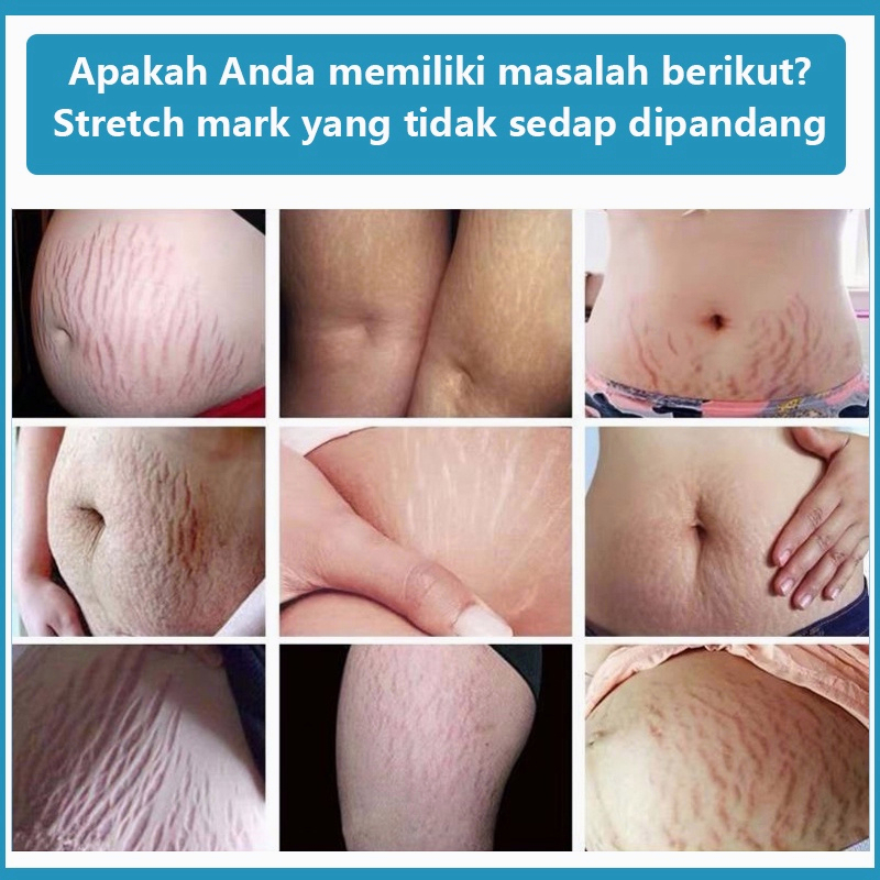 Stretch mark cream Krim stretch mark Secara efektif menghilangkan stretch mark Tujuh hari untuk menghilangkan stretch mark dengan cepat Pilihan banyak ibu