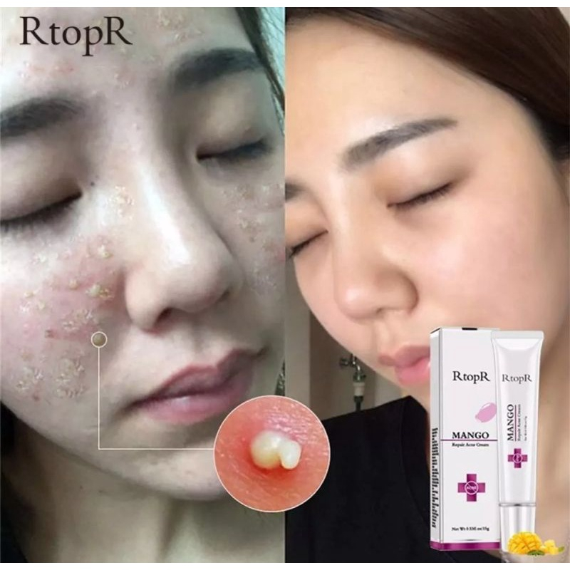 RTOPR MANGO REPAIR ACNE CREAM ANTI ACNE SPOTS ACNE TREATMENT ACNE SCAR BLACKHEAD CREAM-15gr