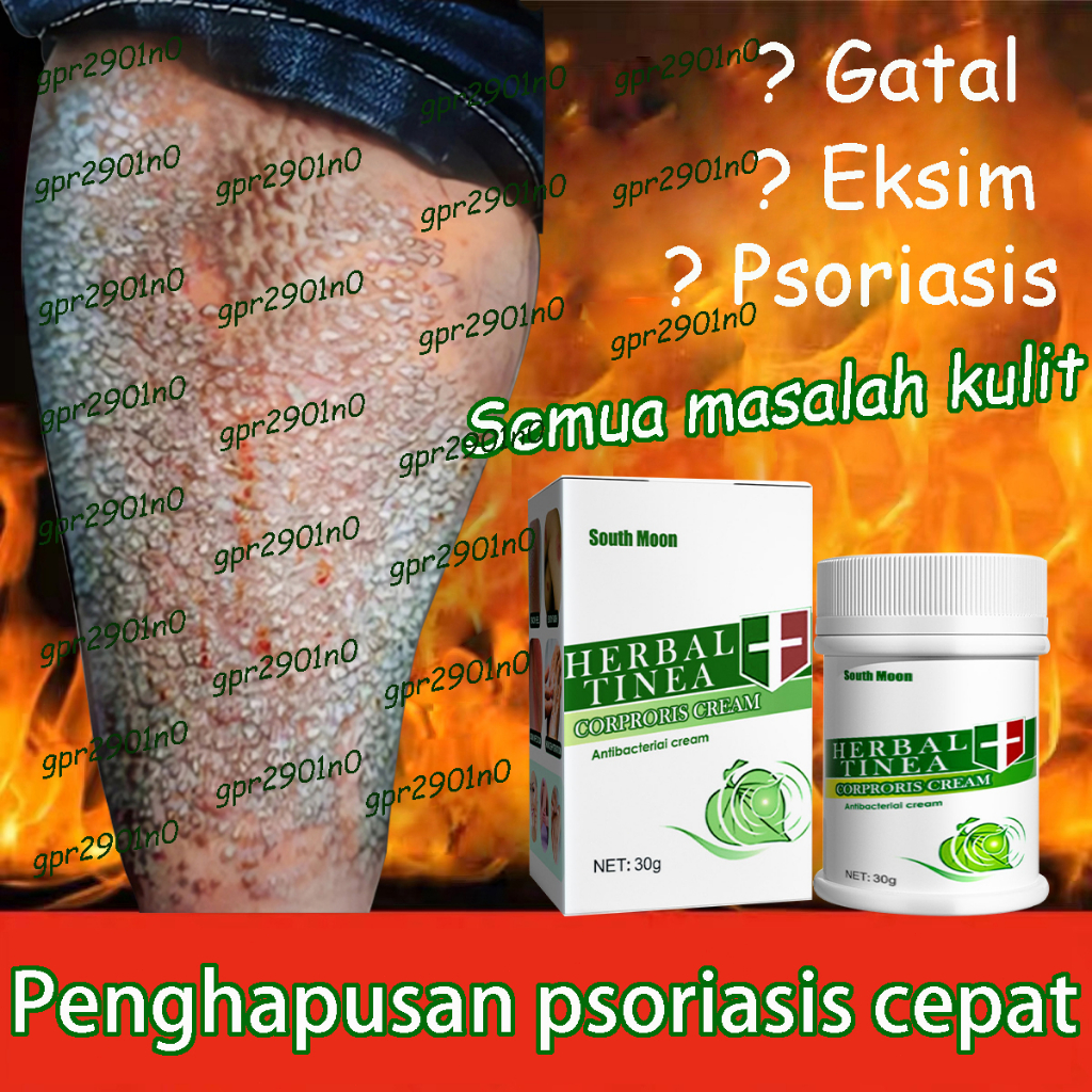 SALEP KULIT EKSIM AMPUH SALEP OBAT EKSIM Salep Asli 100% Original salep gatal/panu / eksim/jamur/kutu air/Jerawat /gatal Salep Obat Jamur Kulit KULIT GATAL SELANGKANGAN JERAWAT