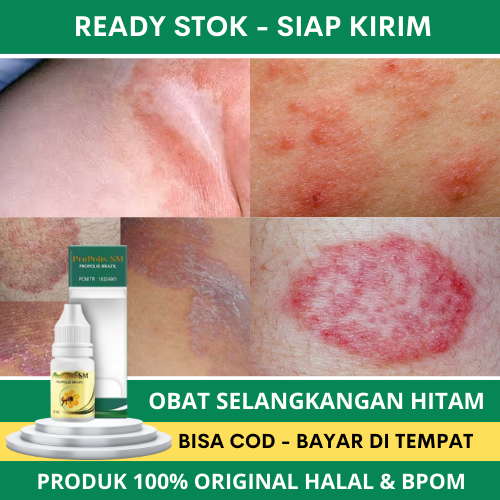 Obat Hitam Selangkangan, Obat Gatal Selangkangan, Salep Gatal Selangkangan, Obat Infeksi Jamur Selan