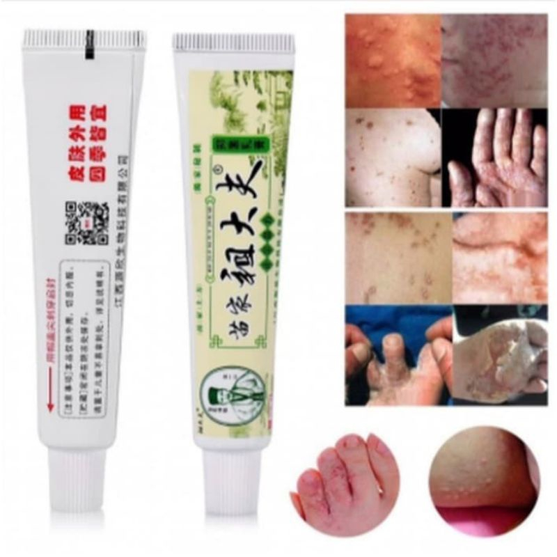 Salep Gatal Jamur Panu Kadas Ruam Eksim Selangkangan / Salep KL / Salep HL / Salep Pi Kang Wang / ZUDAIFU - Salep Sakit Kulit Eksim / Penyakit Kulit Panu Kadas Kurap