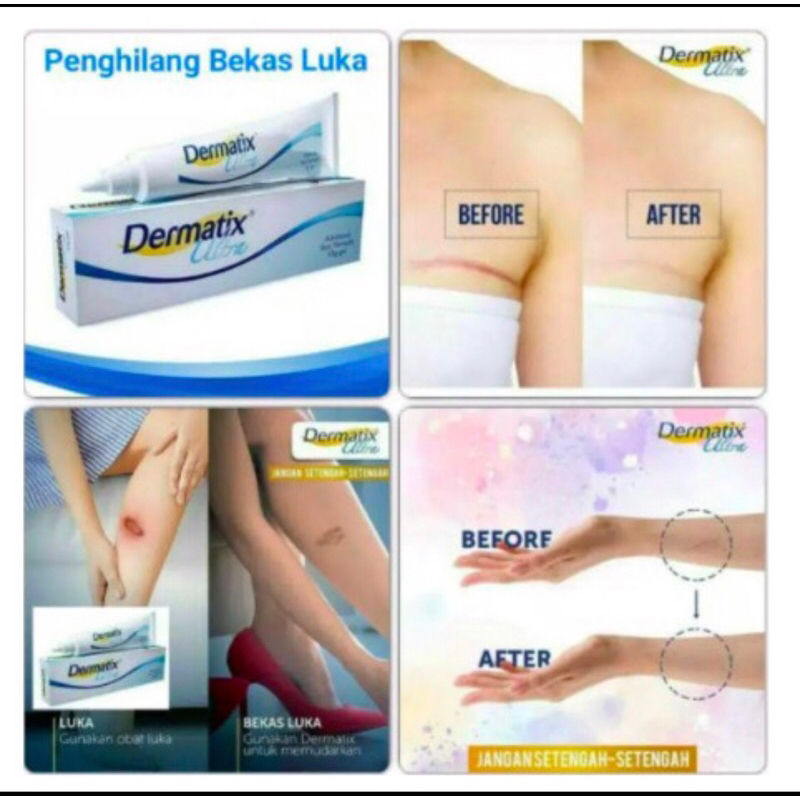 Dermatix Ultra Gel 15g Penghilang Bekas Luka / Keloid ANTI SCAR Stretc
