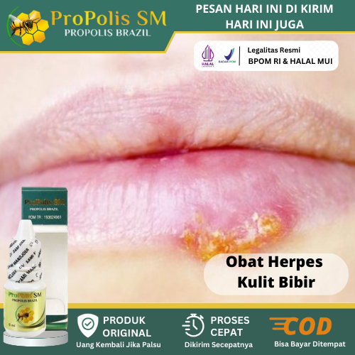 

Obat Infeksi Bibir, Obat Herpes Di Bibir, Obat Herpes Mulut Menahun, Luka Melepuh Sekitar Bibir, Obat Herpes Bibir, Bibir Bengkak Gatal, Infeksi Jamur Di Mulut Dengan Propolis Sm