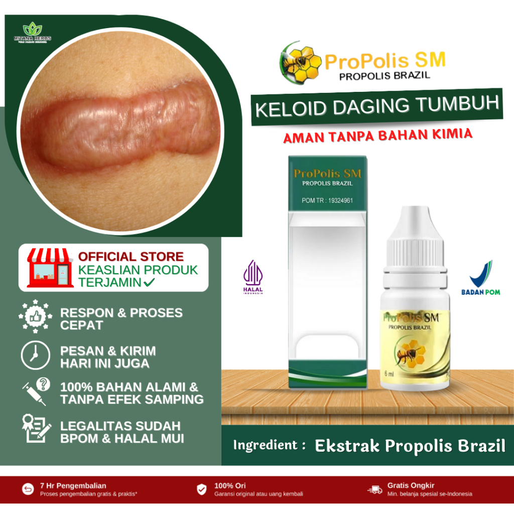 Obat Keloid Daging Tumbuh - Penghilang Keloid Bekas Operasi - Obat Keloid Bekas Operasi - Obat Keloi
