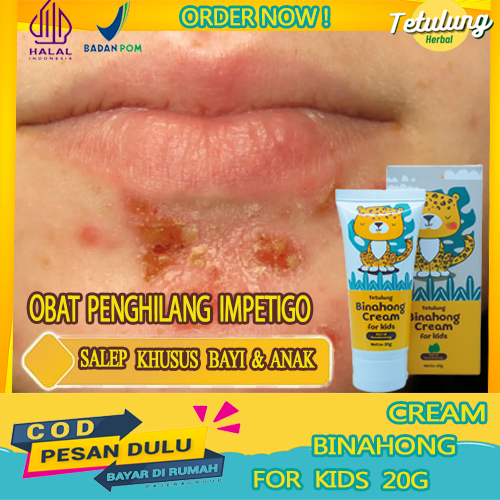 Obat Impetigo, Obat Bercak Merah Impetigo Binahong Cream for Kids Obat Penghilang Impetigo Menular,S