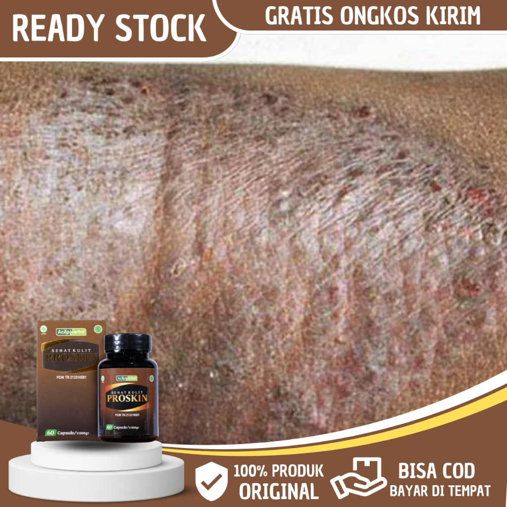 Obat Eksim Kering Menahun, Eksim Kering Basah Psoriasis, Obat Eksim Basah, Salep Eksim, Penghilang G