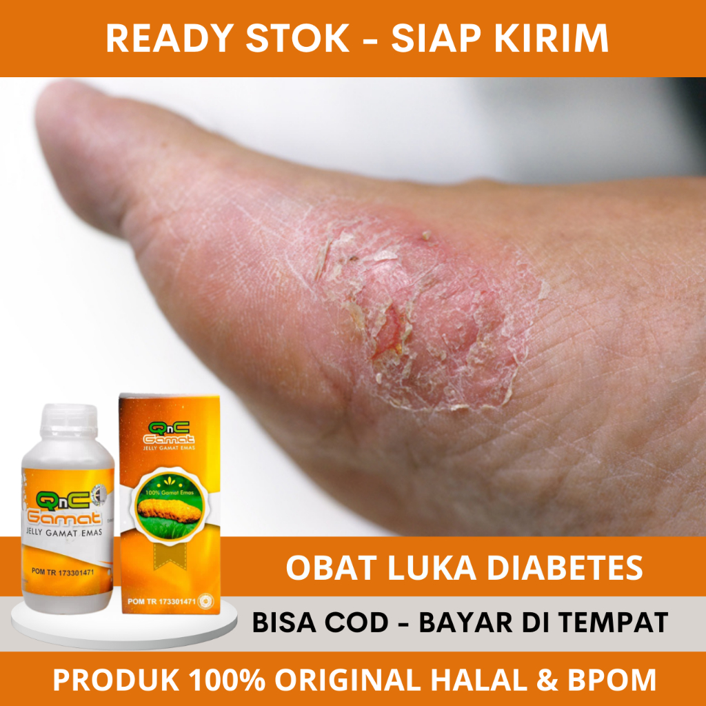Obat Diabetes, Obat Diabetes Kering, Obat Diabetes Basah, Obat Luka Diabetes Agar Cepat Kering, Obat