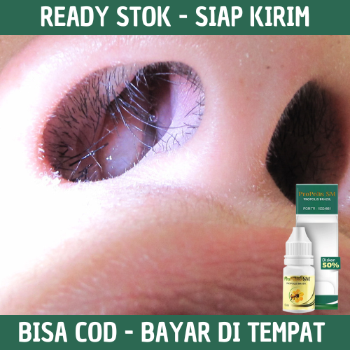 Obat Polip Hidung, Obat Benjolan Di Hidung, Obat Penghilang Polip Hidung, Obat Penghancur Polip Hidu