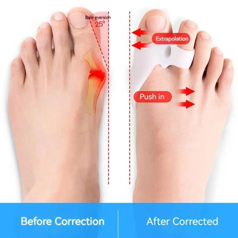 1 Pasang Insole Separator Thumb Silicone / Silikon Pelindung Jempol Kaki / Terapi Jari Kaki