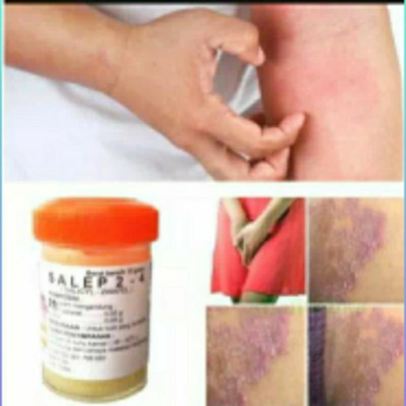 Salep Zwafel Belerang Sulfur 100% Original Salep Jamur, Scabies,  Eksim, kudis, kurap