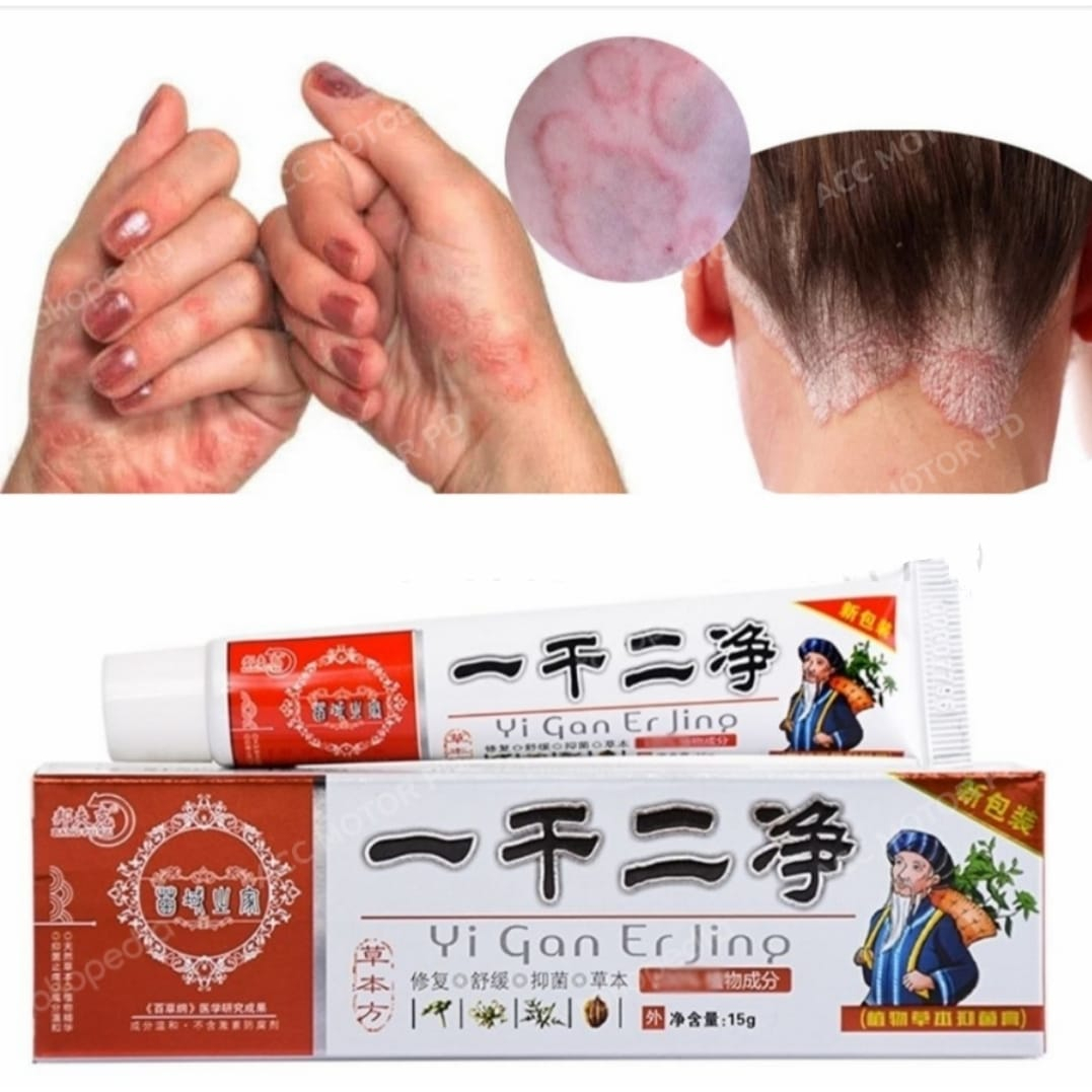 Salep Yi Gan Er Jing Mengatasi Masalah Kulit Gatal Jamur Dan Korengan Ampuh Murah