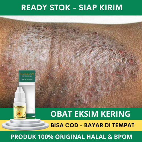 Obat Eksim Kering Menahun, Obat Eksim Basah dan Kering Menahun, Obat Eksim Menahun, Eksim Basah, Eks