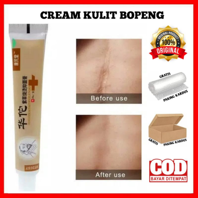 CREAM KULIT BOPENG DAN KELOID