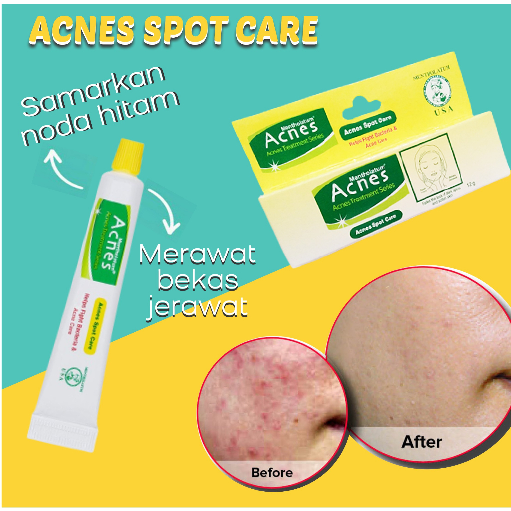 [BPOM] Acnes Spot Care 12gr / Krim Jerawat / Anti Jerawat / Acne Care Treatment / MY MOM