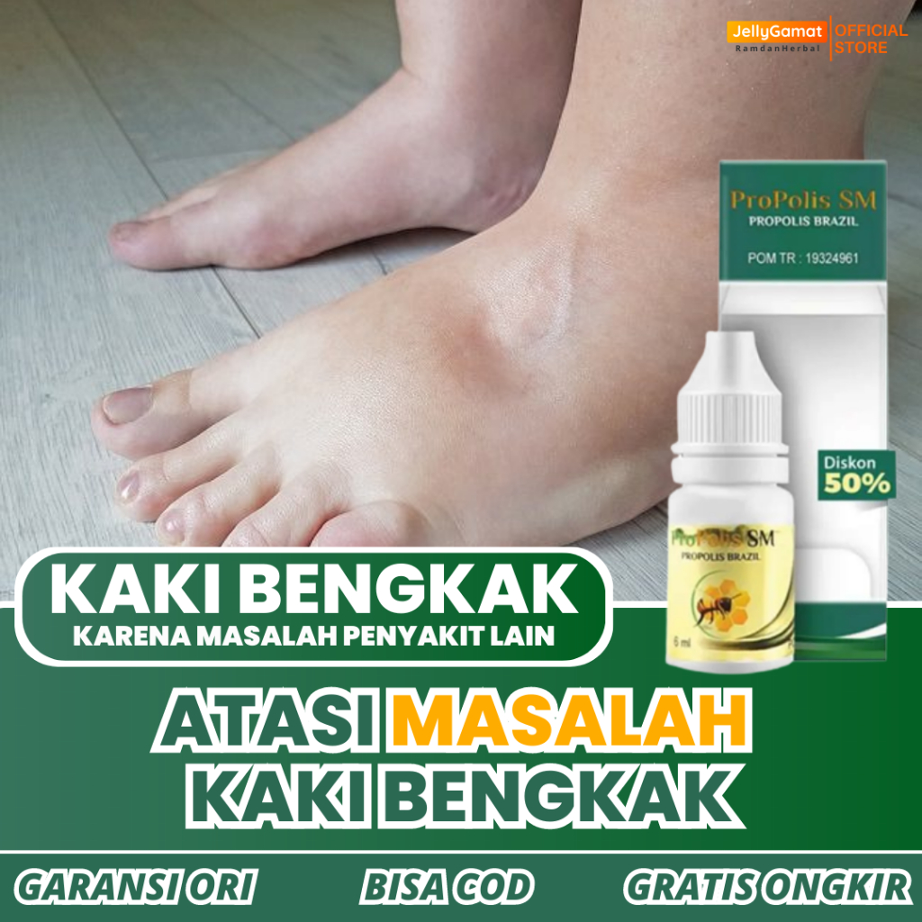[COD] Obat Kaki Bengkak Di Apotik, Kaki Bengkak Karena Jantung, Kaki Bengkak Asam Urat, Kaki Bengkak