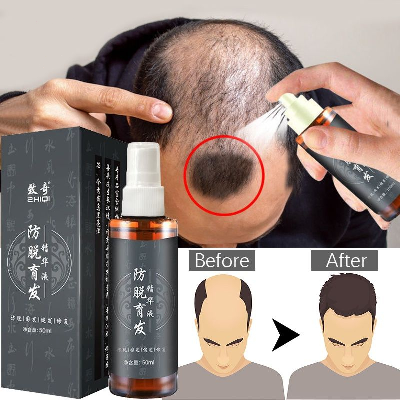 ZHIQI Obat Serum Penumbuh Rambut Cepat Hair Tonic Spray Penumbuh Rambut Botak Pria Hair Growth Spray 100ml