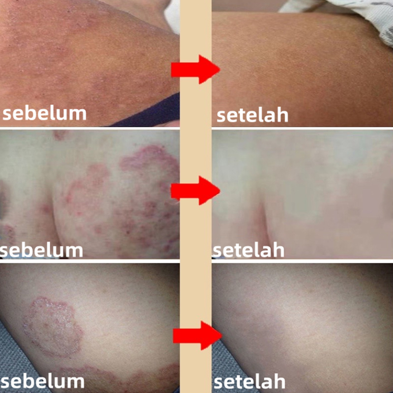 Obat Gatal Selangkangan Salep Gatal Paling Ampuh Kebersihan Kulit Menghilangkan Bau Krim Psoriasis Eczema Anti-Itching Cream selangkangan dan kelamin selangkangan dan kelamin Anti jamur obat panu kadas Salep Obat Jamur Kulit kadas selangkangan