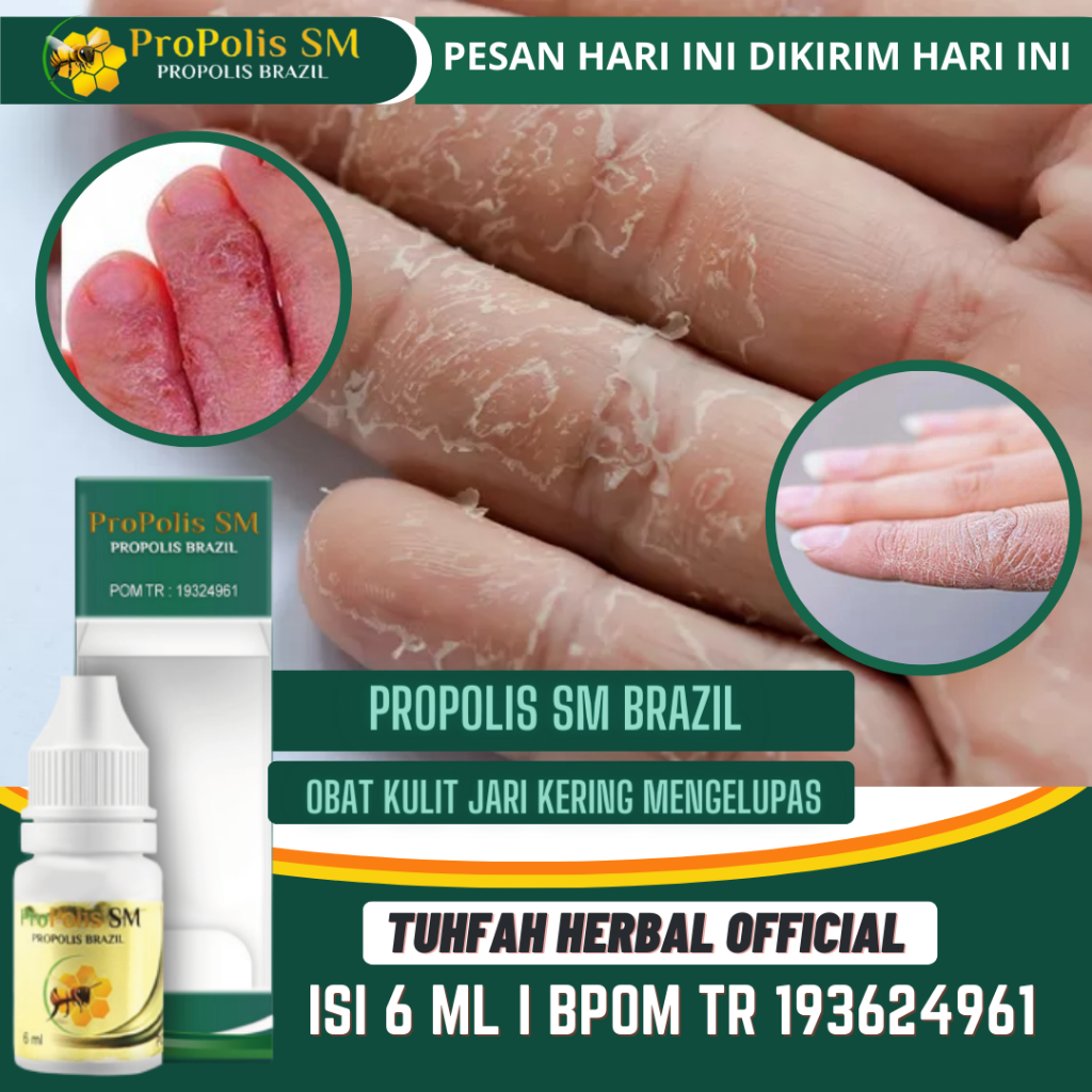 Obat Jari Tangan Kering, Obat Kulit Jari Mengelupas, Obat Telapak Tangan Kering dan Kasar, Telapak T