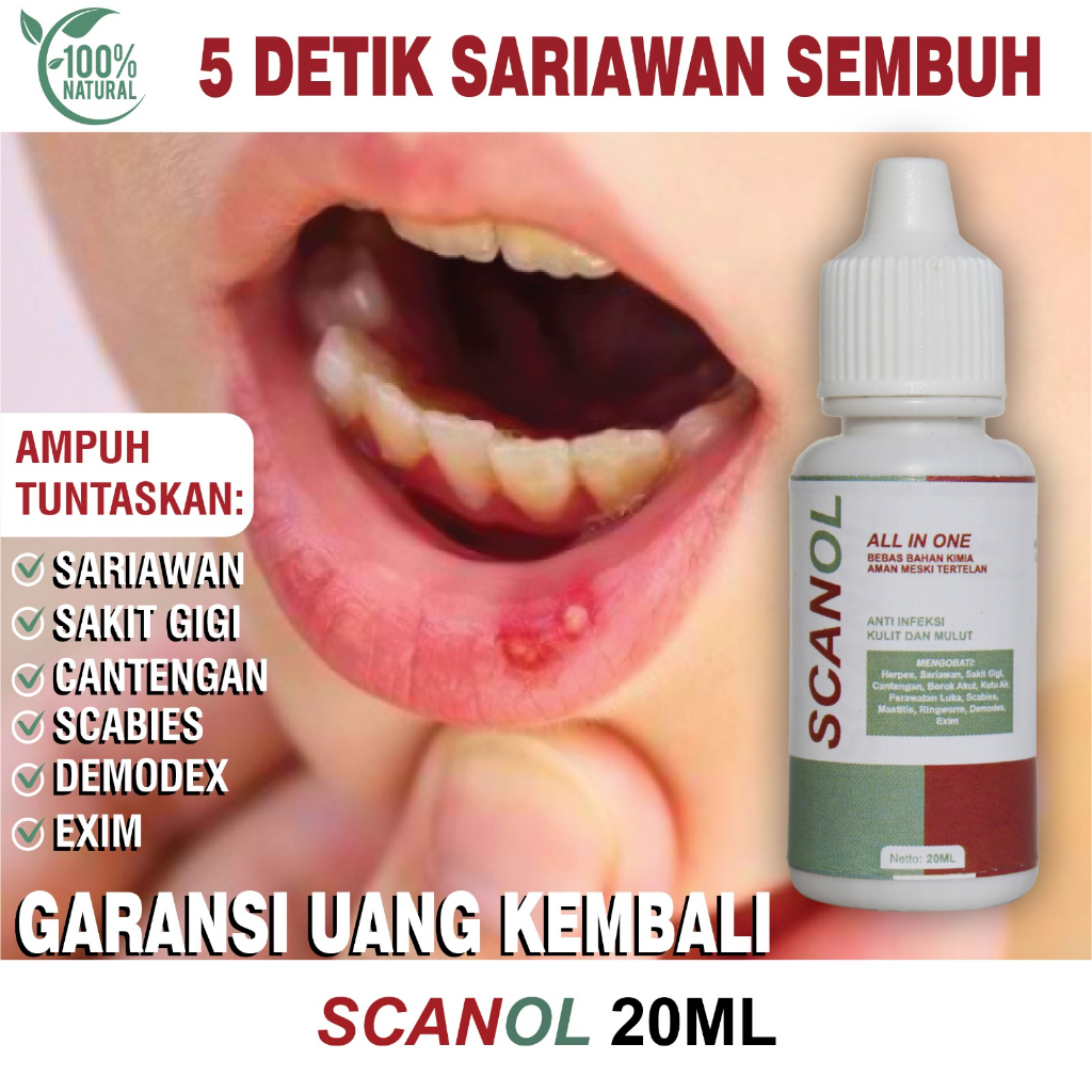Obat Tetes Sariawan Mulut, Sariawan Bayi/Dewasa, Sariawan Bibir, Menahun Radang Sariawan, Sariawan d