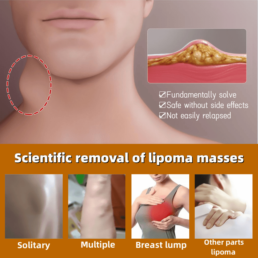 Obat Benjolan Lipoma Krim lipoma OBAT OLES PENGHILANG BENJOLAN LIPOMA 30g