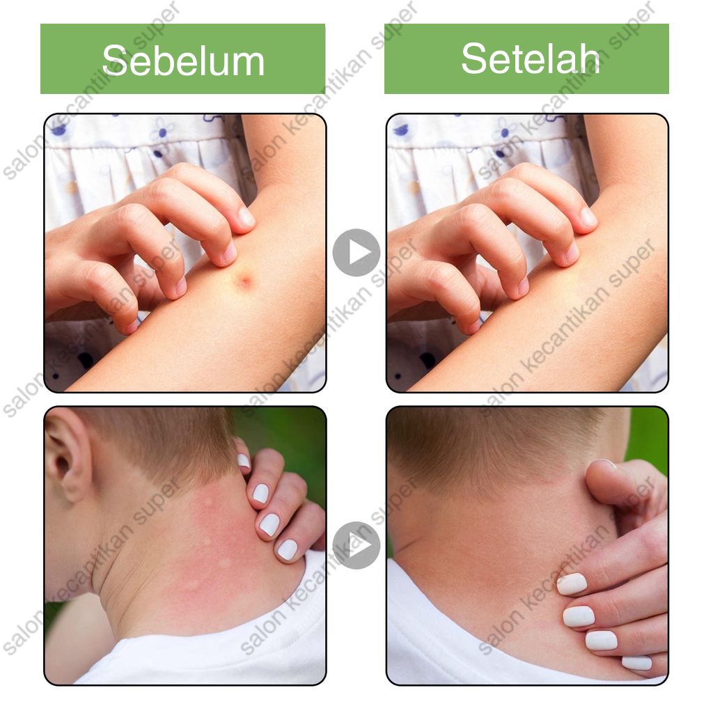 [100% Asli ] Salep gatal Obat gatal paling ampuh Obat gatal kulit 20g Anti gatal cepat/krim  gigitan nyamuk anti-gatal/Balsem gigitan tungau/menghilangkan pembengkakan/Bumil dan bayi dapat menggunakan