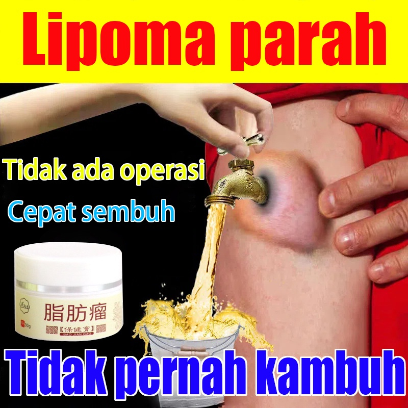 obat benjolan lipoma obat benjolan di leher kepala tangan Punggung lipoma cream original Krim lipoma