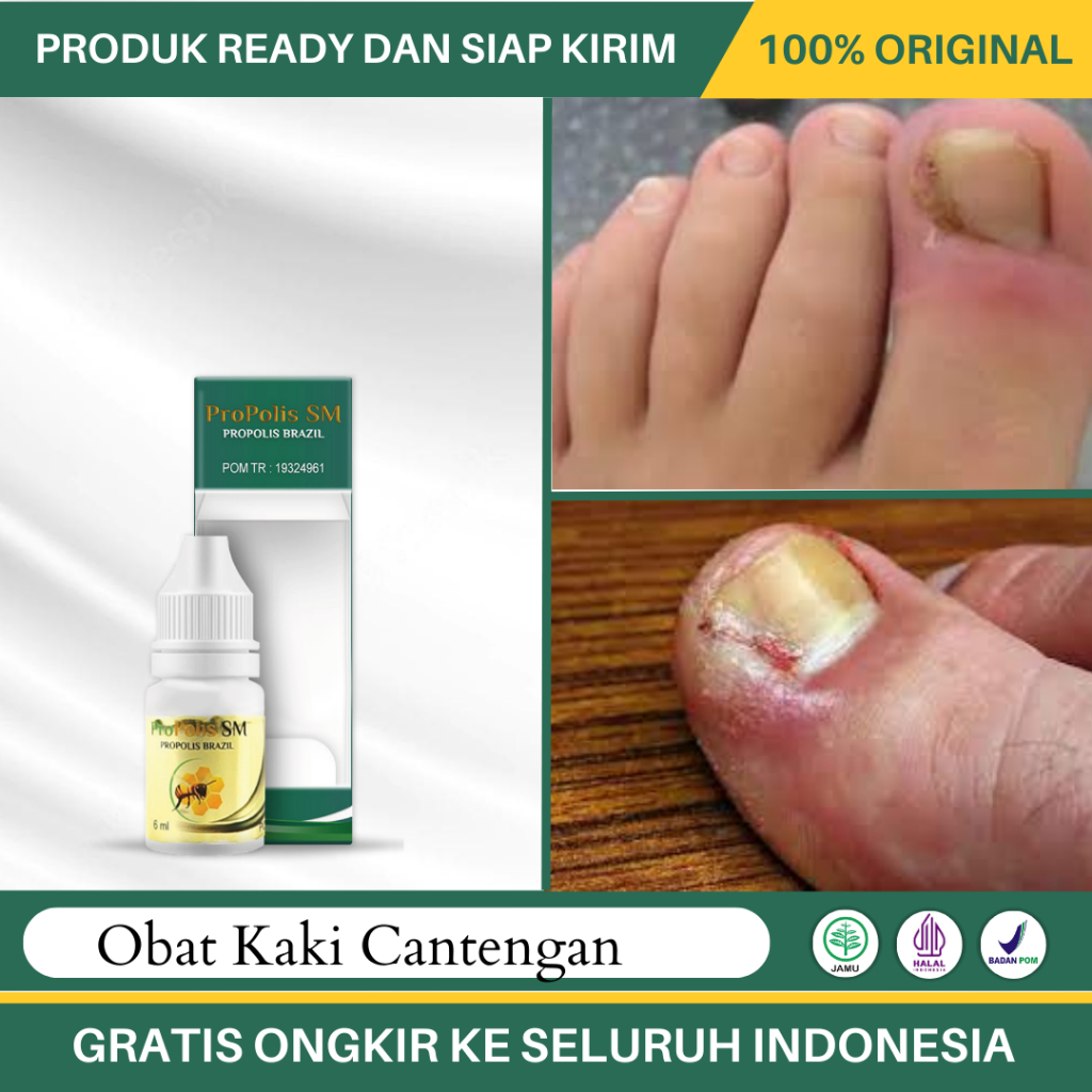Obat Cantengan, Kuku Jempol Kaki Bernanah dan Berdarah, Obat Kuku kaki Bau Busuk dan Nyeri - Propoli