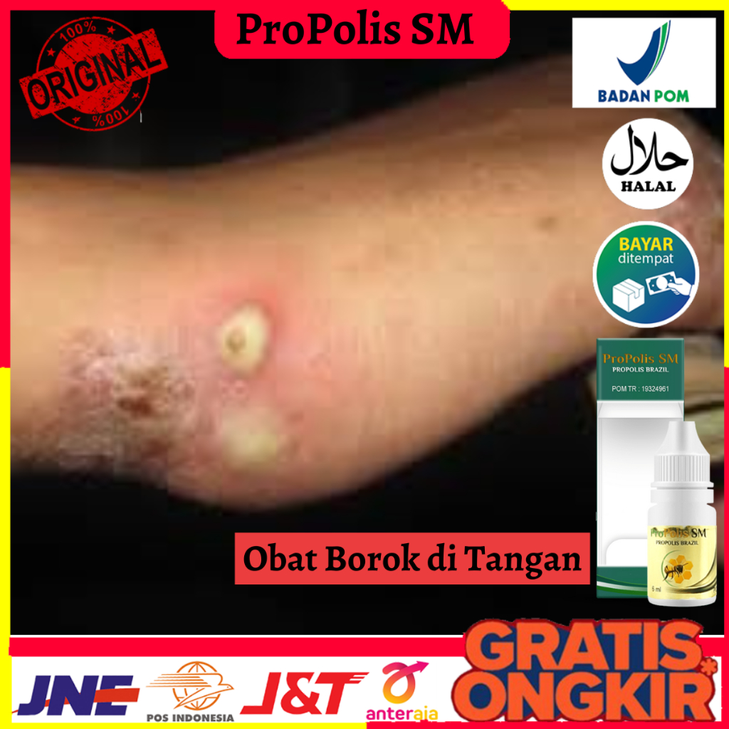 Obat Borok di Tangan, Obat Gatal Bernanah, Obat Budug anak / Dewasa, Obat Gudig, Obat Scabies Manusi