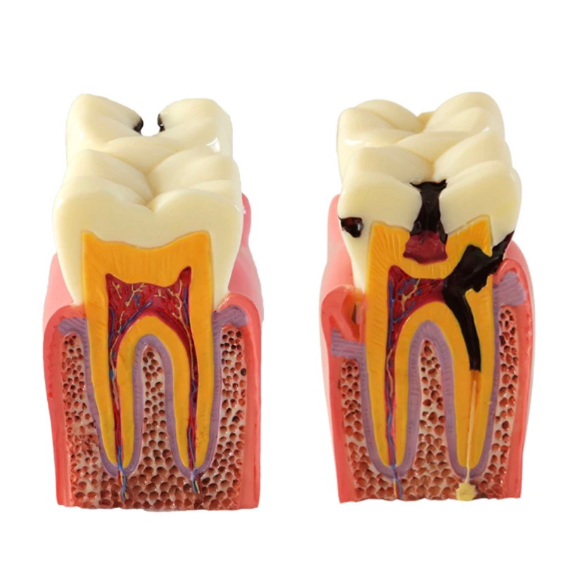 Model gigi anatomi karies