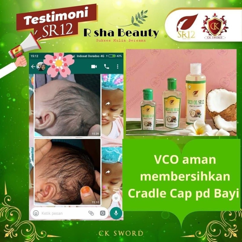 MINYAK KELAPA ASLI , VCO OIL , VCO SR12 , MENGATASI CRADLE CRAP PADA BAYI , OBAT ALERGI BAYI , MINYAK URUT BAYI