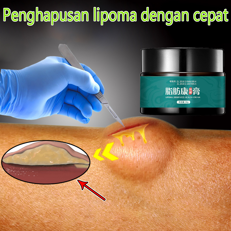 Obat Herbal Benjolan Lipoma, Obat Benjolan Lipoma LIPOMA DISSIPATES HEALTH CREAM 30g Minyak Oles Pen