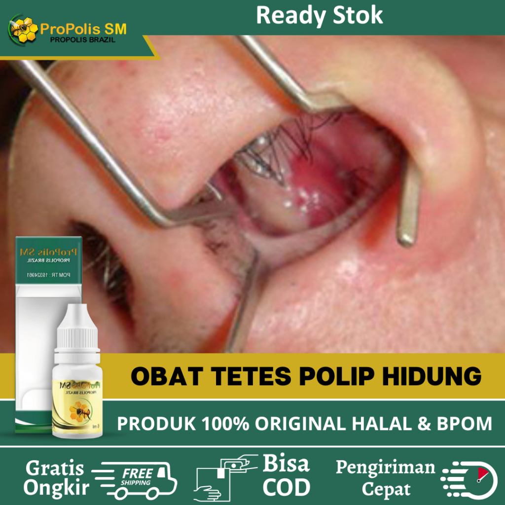Obat Tetes Polip Hidung, Obat Penyakit Polip Hidung, Perontok Benjolan Di Dalam Hidung, Polip Sinusi