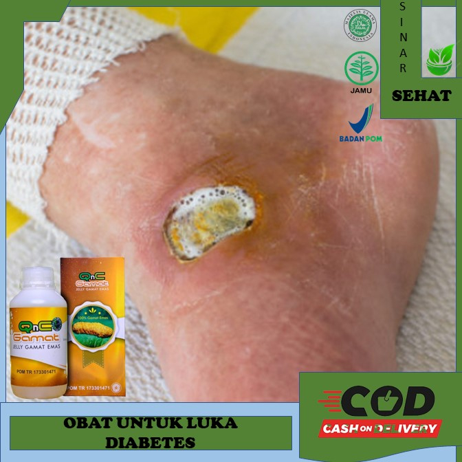 obat luka diabetes Obat Herbal Untuk Luka Obat Luka Diabetes Basah Agar Cepat Kering - Luka Diabetes