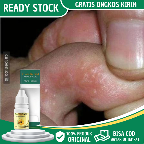 Obat Gatal Berair Di Jari Tangan Dan Kaki - Obat Gatal Berair Di Sela Jari Tangan - Obat Gatal Berai