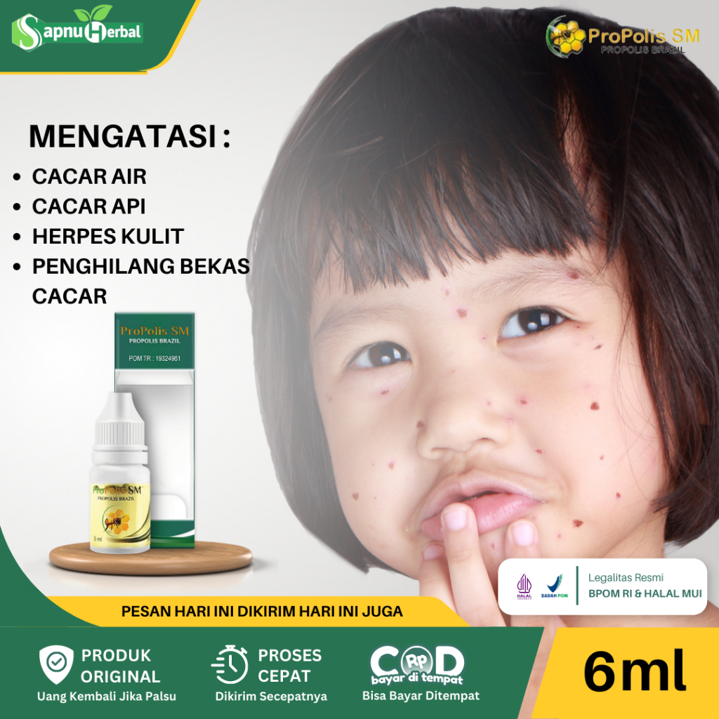 Obat Cacar Air, Obat Cacar Api, Obat Penghilang Bekas Cacar, Obat Herpes Kulit, Obat Cacar Monyet, O