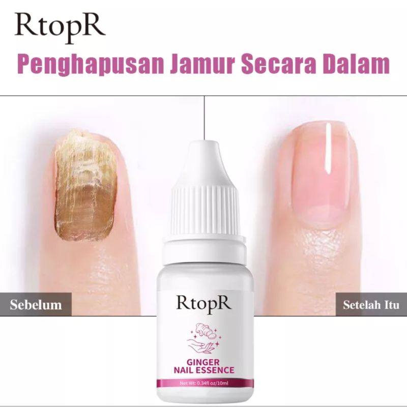 RtopR NAIL TREATMENT | PERAWATAN JAMUR KUKU |