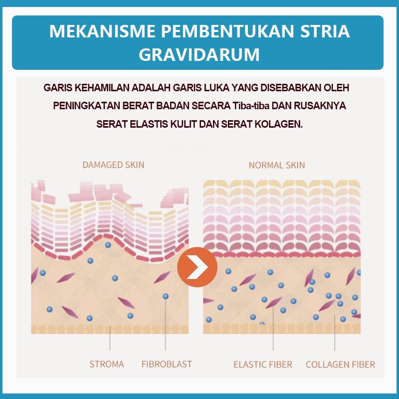 Stretch mark cream Krim stretch mark Secara efektif menghilangkan stretch mark Tujuh hari untuk menghilangkan stretch mark dengan cepat Pilihan banyak ibu