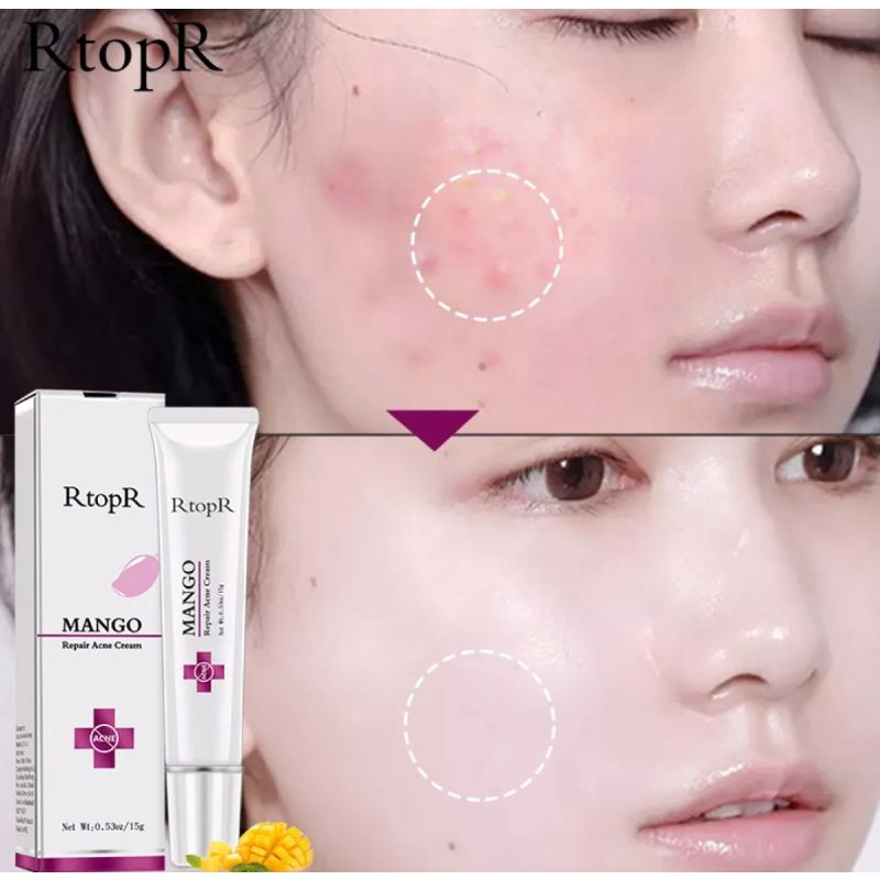 RTOPR MANGO REPAIR ACNE CREAM ANTI ACNE SPOTS ACNE TREATMENT ACNE SCAR BLACKHEAD CREAM-15gr