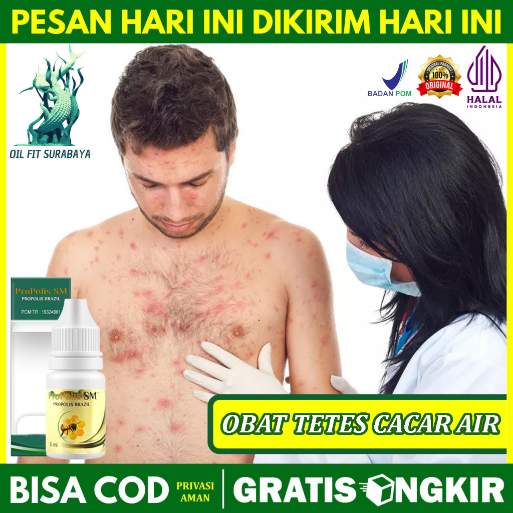 Obat Cacar Air Cacar Api Cacar Monyet Penghilang Bekas Cacar Herpes Campak Agar Cepat Sembuh