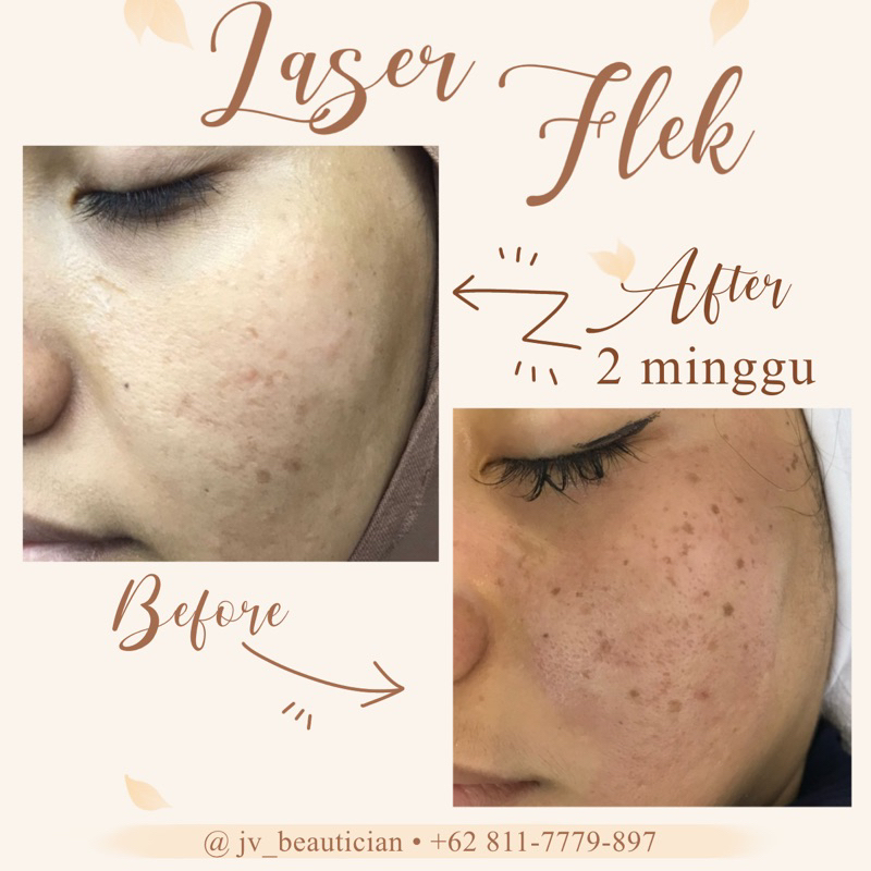 LASER FLEK WAJAH