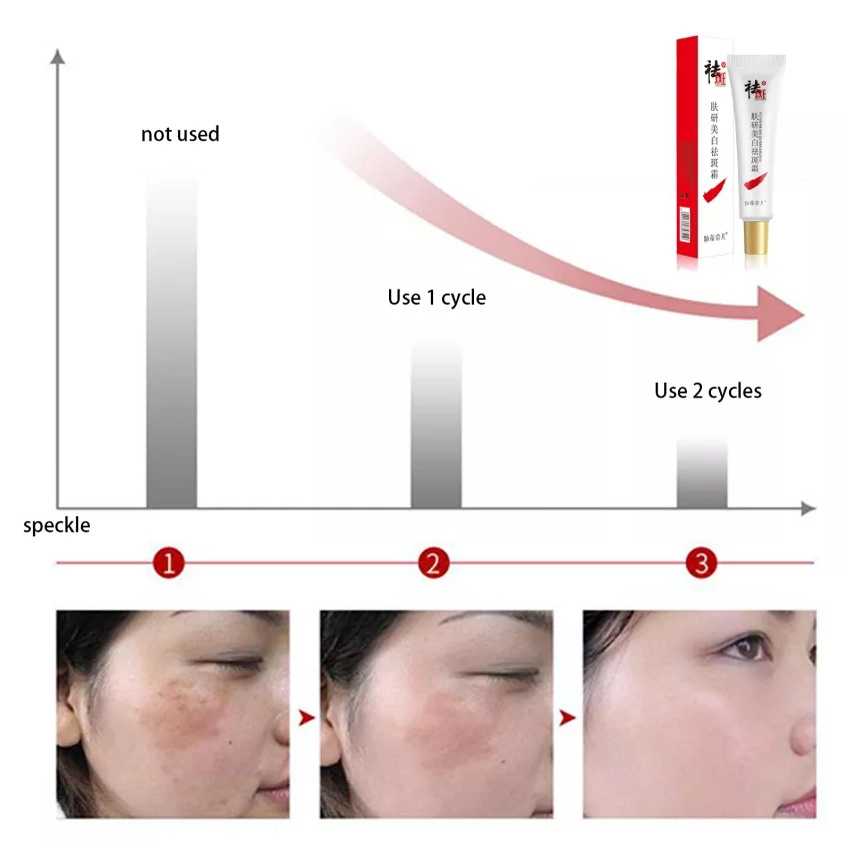 CINDYNAL Whitening Freckle Cream Remove Penghilang Noda Kulit Krim Wajah Pemutih Krim Pemutih Penghilang Bintik Jerawat Melasma Melanin Salep Pigmen