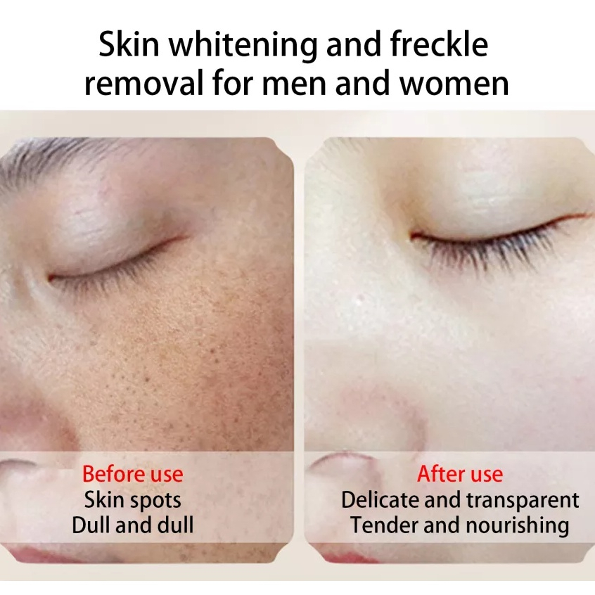 CINDYNAL Whitening Freckle Cream Remove Penghilang Noda Kulit Krim Wajah Pemutih Krim Pemutih Penghilang Bintik Jerawat Melasma Melanin Salep Pigmen