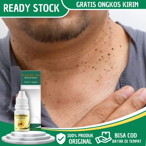 Obat Papiloma, Obat Perontok Papiloma, Obat Penghilang Papiloma di Leher, Obat Penghilang Papiloma D