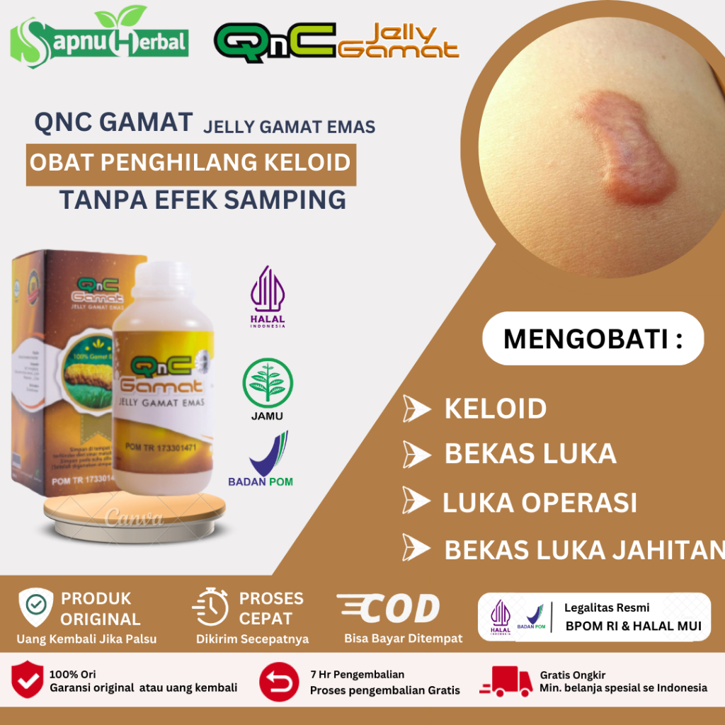 Sapnu Herbal - Obat Keloid Penghilang Bekas Luka, Keloid Menahun, Keloid Menonjol Tahunan, Keloid Da