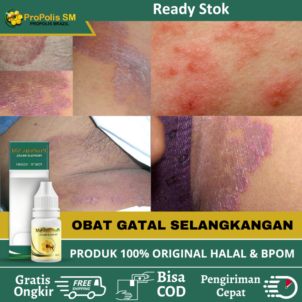 Obat Gatal Selangkangan, Obat Selangkangan Hitam, Pemutih Selangkangan, Salep Gatal Selangkangan, Ob