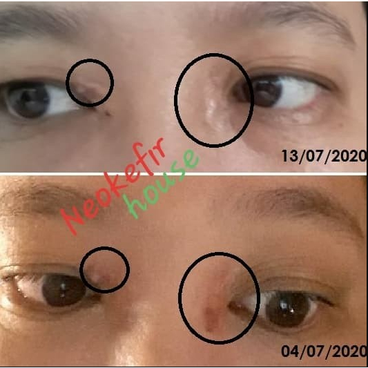Cream Penghilang Xanthelasma Cream Kemasan 10gr