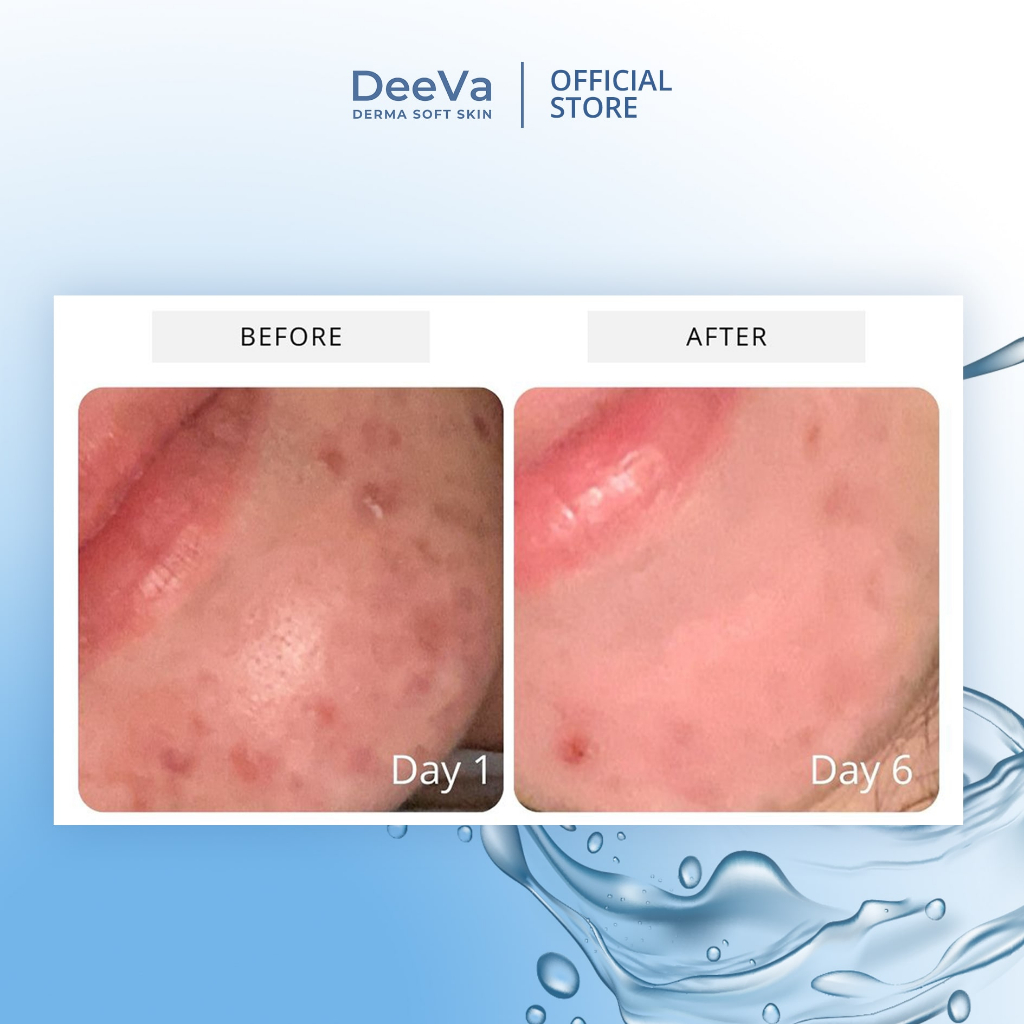 DeeVa Derma Soft Skin - Paket Glow and Shine (untuk kulit kering, kusam, dark spots)