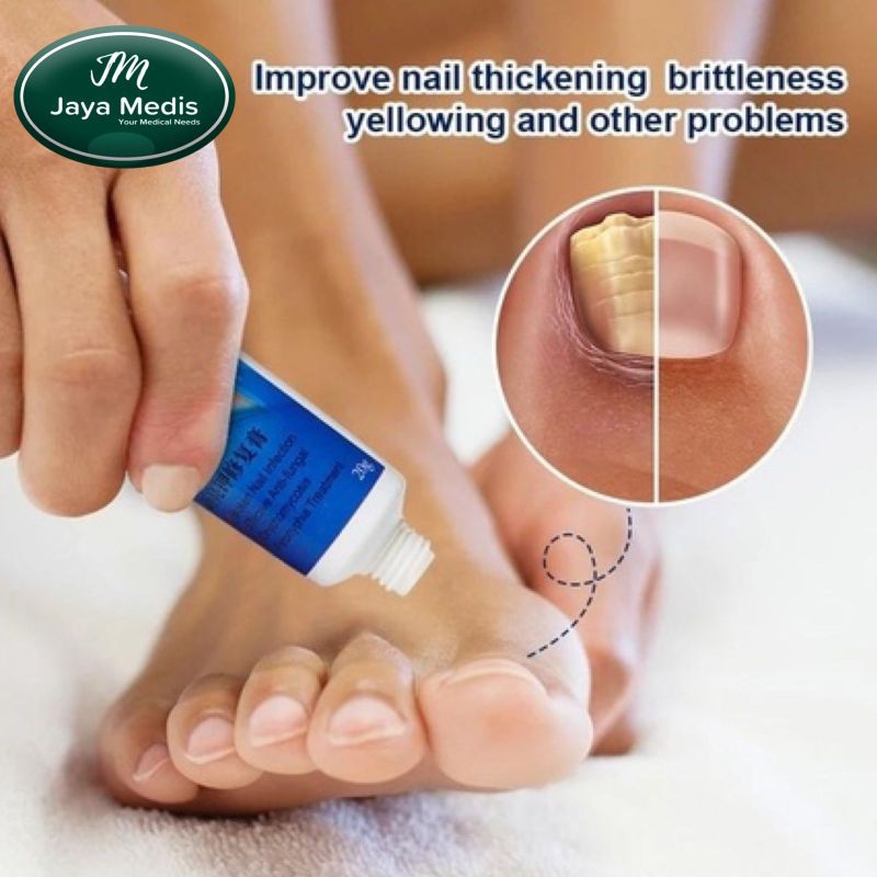 SALEP KUKU CANTENGAN NAIL FUNGUS TREATMENT - PERAWATAN JAMUR KUKU