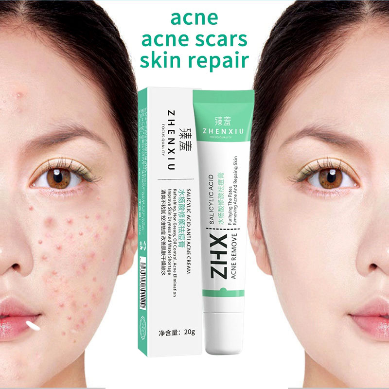 ZHENXIU Salicylic Acid Acne Treatment Cream 20Gr-Krim Anti Jerawat Salep Jerawat Menghilangkan Jerawat Memperbaiki Kulit Penghilang Bekas Luka