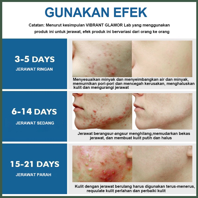 ZHENXIU Krim Anti jerawat dan Memudarkan bekas jerawat Cepat Salep Jerawat 20g Original Anti acne Herbal Essence Menghilangkan Jerawat Memperbaiki Kulit Pria dan Wanita